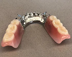 Partial cast dentures